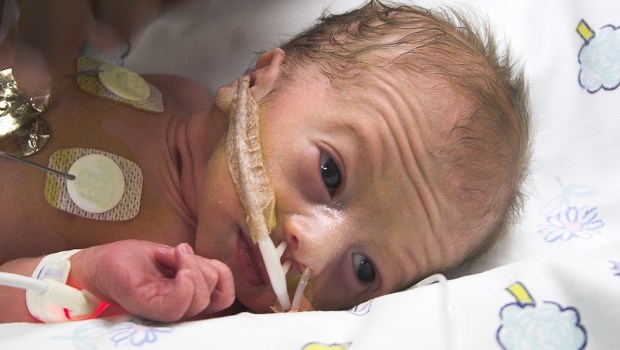 PREMATURE BABY