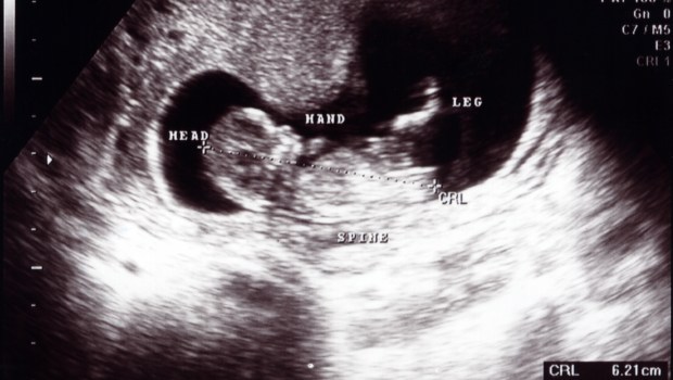 ULTRASOUND